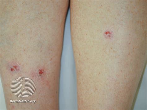 Filesuperficial Basal Cell Carcinoma Leg Dermnet Nz Sbcc Leg 19 Dn