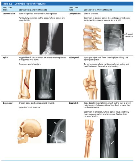 Common Fractures