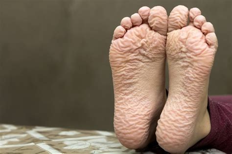 In a typical foot the tibia is responsible for supporting about 85% of body weight. Trench Foot