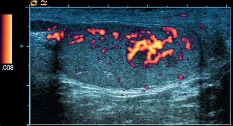Testicular Cancer Ultrasound Scan Photograph By Du Cane Medical Imaging Ltd