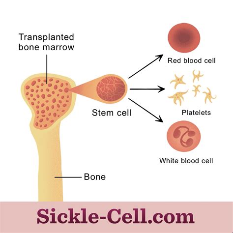 About Sickle Cell Anemia Treatment By Bone Marrow Transplant In India