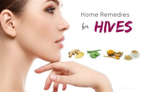 How To Treat Hives Permanently Naturally At Home Home Remedies For