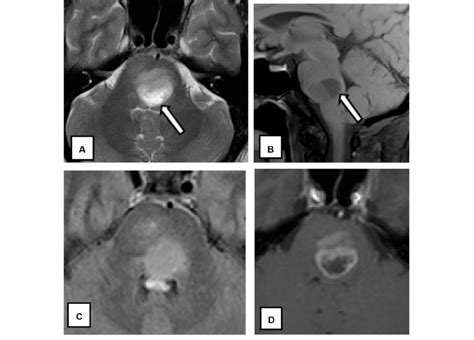 A Year Old Male With Bilateral Trigeminal Neuralgia Mri Of The Download Scientific Diagram