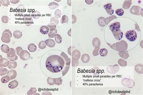 Babesia Spp On Peripheral Blood Smear Microscopy Grepmed