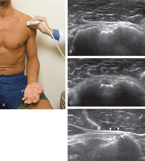 Quick Guide To Shoulder Ultrasound Sports Medicine Review