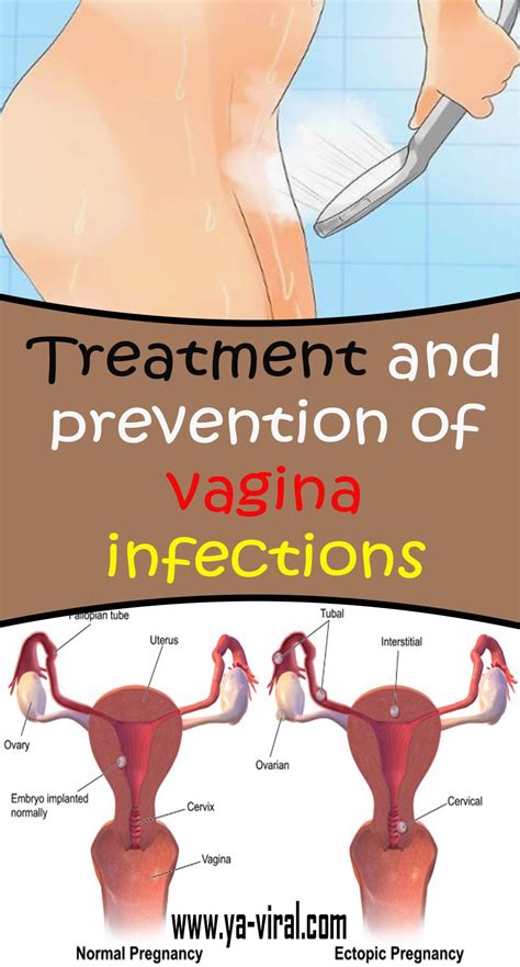 Treatment And Counteractive Action Of Vaginal Diseases Fredtrouck