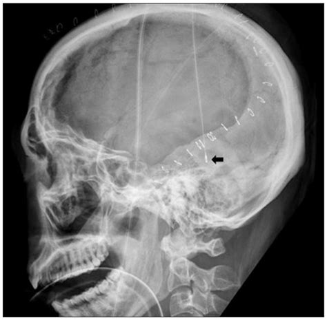 Lateral Plain Radiograph Of The Skull Shows Subdural Intracranial