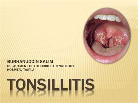 Tonsilitis