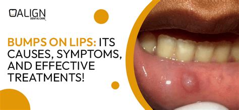 Bumps On Lips Causes Symptoms And Natural Remedies Udentalstuff0