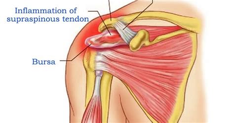 Supraspinatus Tendonitis The Causes Of Supraspinatus Tendinitis Can Be