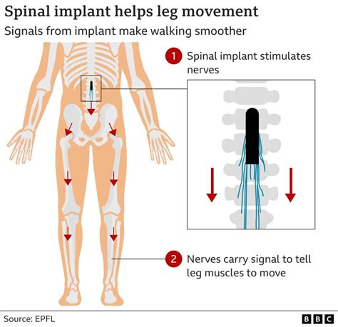 Parkinson S Implant Restores Man S Ability To Walk Bbc News