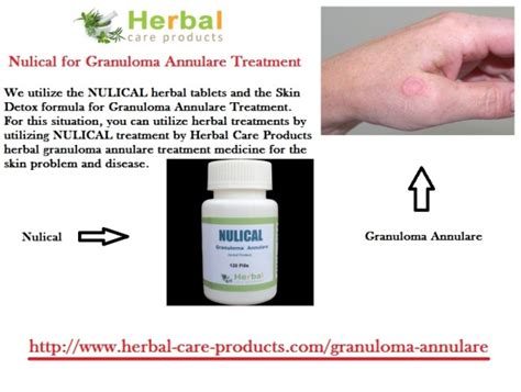 Herbal Products For Granuloma Annulare Treatment Herbal Care Products