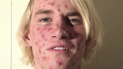 Zit Face Guy Pimple Acne Explosion Youtube