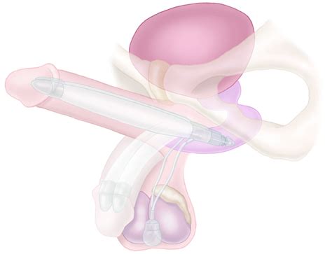 Boston Scientific Penile Implants Penile Prosthesis Erectile Dysfunction Shu Pan Md