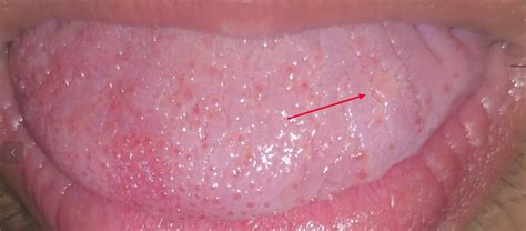 Is This An Hpv Tongue Wart Rhpv