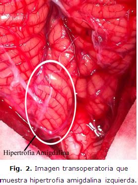 They're also part of your lymphatic system. HIPERTROFIA AMIGDALINA UNILATERAL PDF