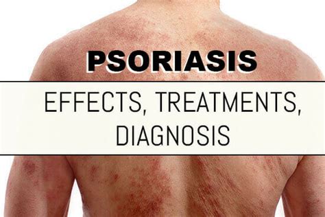 The Diagnosis Effects And Treatment Of Psoriasis Dualight High