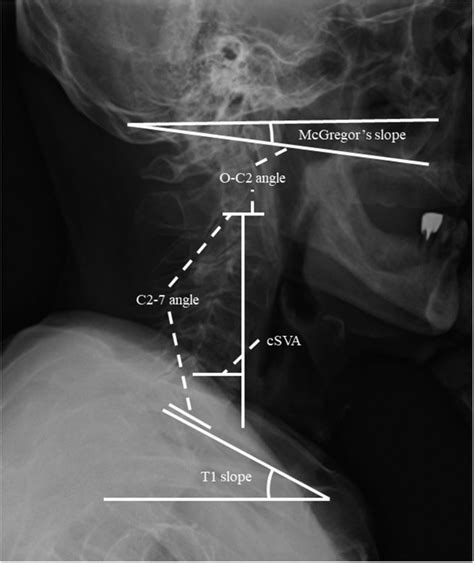 Radiographic Assessment Of The Cervical Spine In Patients With Cervical