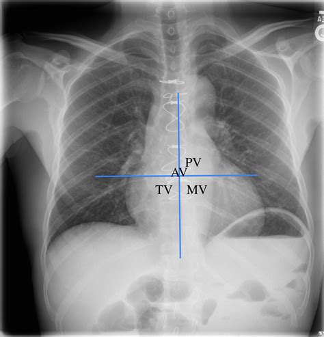 Anticipated Valve Locations On Chest Xray These Grepmed