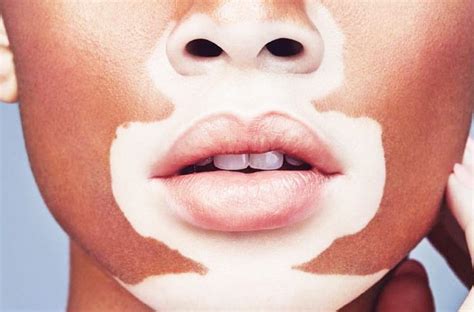 What Is Solution To Lip Vitiligo Kaya Kalp Global — Vitiligo And