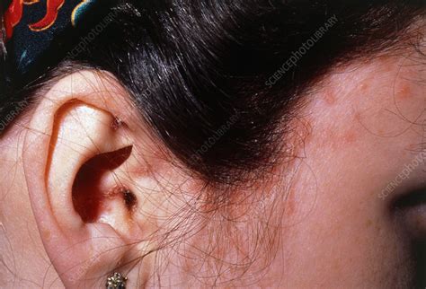 Guttate Psoriasis Lesions On Side Of Head Stock Image M2400166