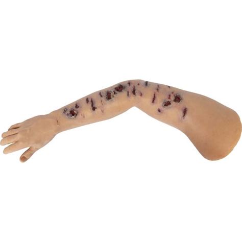 Tommanikin Right Arm W Shrapnel Injuries North American Rescue