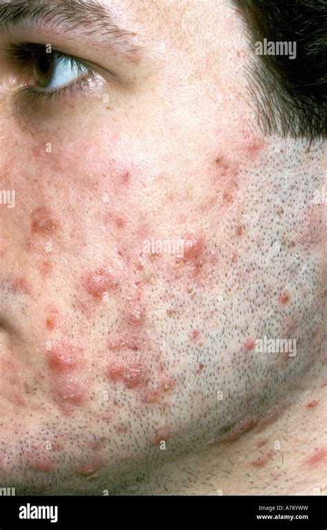 Nodulocystic Acne Hi Res Stock Photography And Images Alamy
