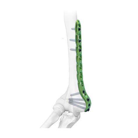 Distal Medial Humeral Reconstruction Locking Platetwin Holemedical