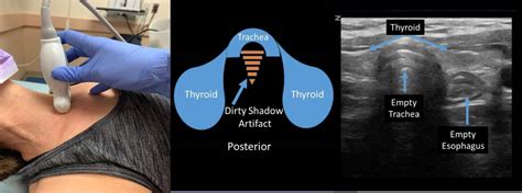 Point Of Care Ultrasound Pediatric Ett Confirmation Aliemu