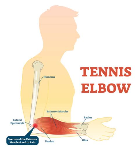 Human Elbow Joint Diagram Silhouettes Illustrations Royalty Free