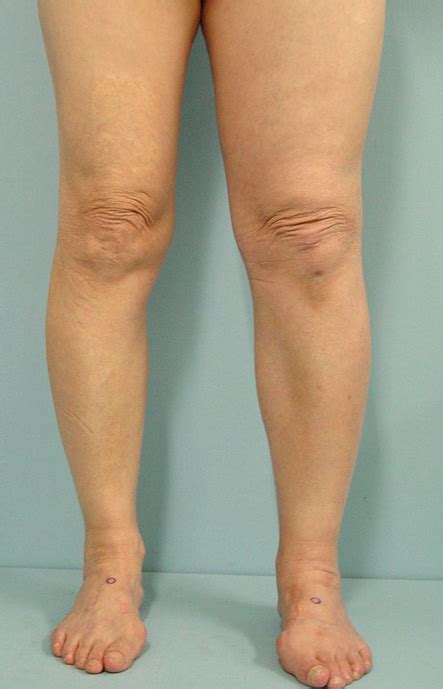 a photograph showing the swelling of the left leg download scientific diagram