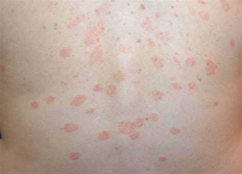 Pityriasis Rosea Pictures Causes Symptoms Treatment Home Remedies
