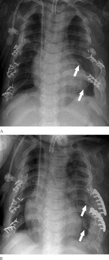 Lateral Thoracic Expansion For Jeune Syndrome Evidence Of Rib Healing