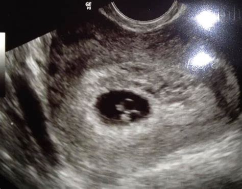 Fraternal Twins Ultrasound 6 Weeks
