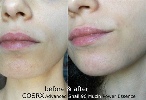 Cosrx advanced snail 92 all in one cream. Before and after picture using CORSX Advanced Snail 96 ...