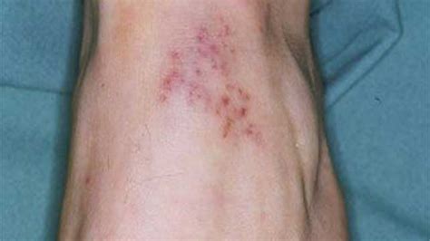 Bacterial Meningitis Skin Rash Adults
