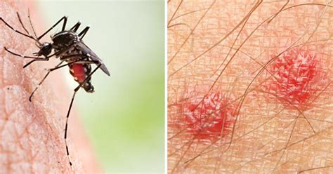 Do Your Mosquito Bites Swell And Sting It Is Possible You Have Skeeter Syndrome