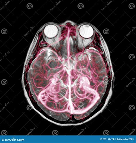 Mra Magnetic Resonance Angiography Of Brain For Stroke Patient