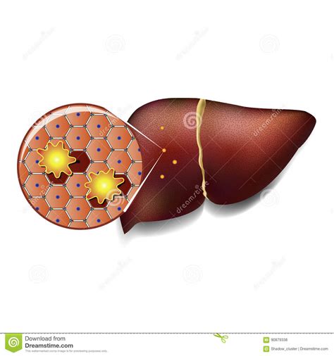 Liver Cells Attacked By Toxins Stock Vector Illustration Of Infection
