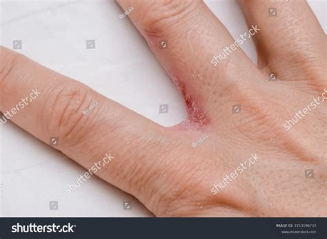 Hand Interdigital Dermatitis Dyshidrotic Eczema On ภาพสต็อก 2213196733