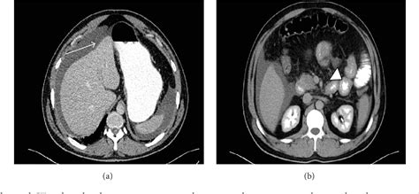 Figure 1 From A Case Of Eosinophilic Gastroenteritis With Ascites