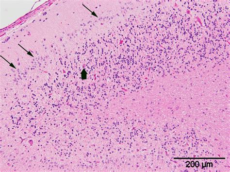 Cerebellar Folium With Hypocellular Granular Layer And Ectopic Neurons