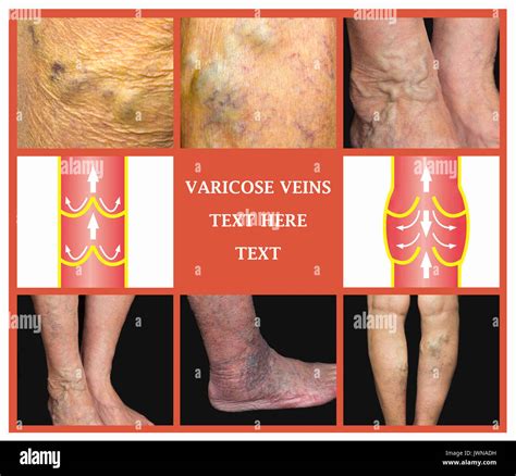 Varicose Veins On A Female Senior Leg Stock Photo Alamy