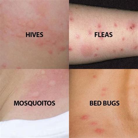 Image Of What Different Bitesskin Conditions Look Like Bed Bug