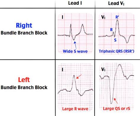 Rosh Review Bundle Branch Block Cardiac Nursing Icu Nursing