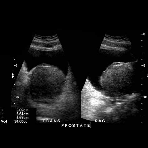 Benign Prostatic Hyperplasia Ultrasound