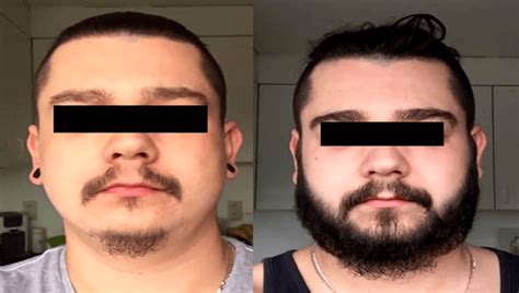 How to choose a minoxidil before and after beard style? Top 10 Minoxidil Before and After Beard Growth Transformation - Beardsome