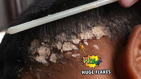 Dry Scalp Big Flakes Dandruff Scratching Satisfying Video 1008