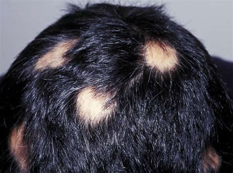 Thinning Hair And Itchy Scalp