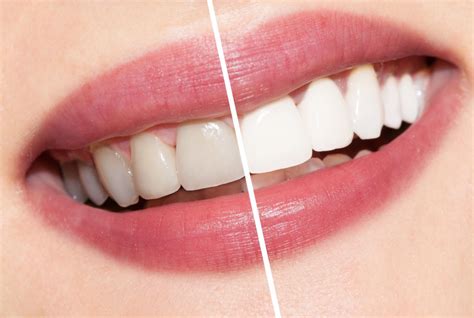 Teeth Whitening Secrets